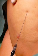 Laser Lipo